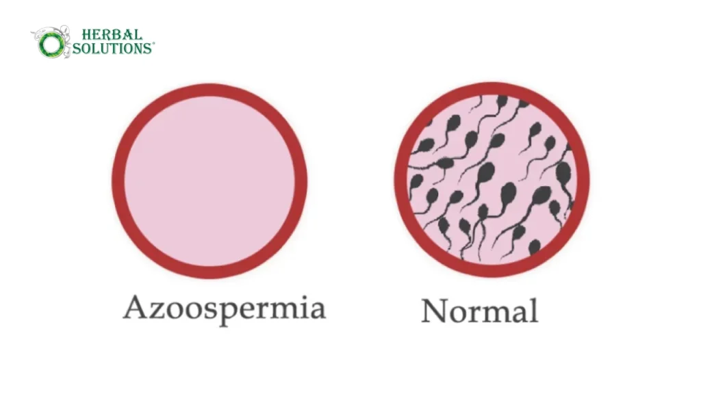 Natural Azoospermia Treatment
