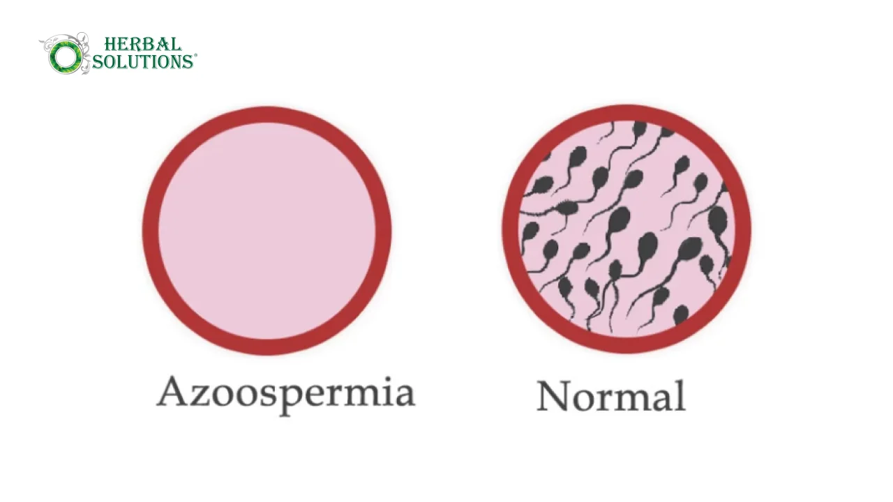 Natural Azoospermia Treatment