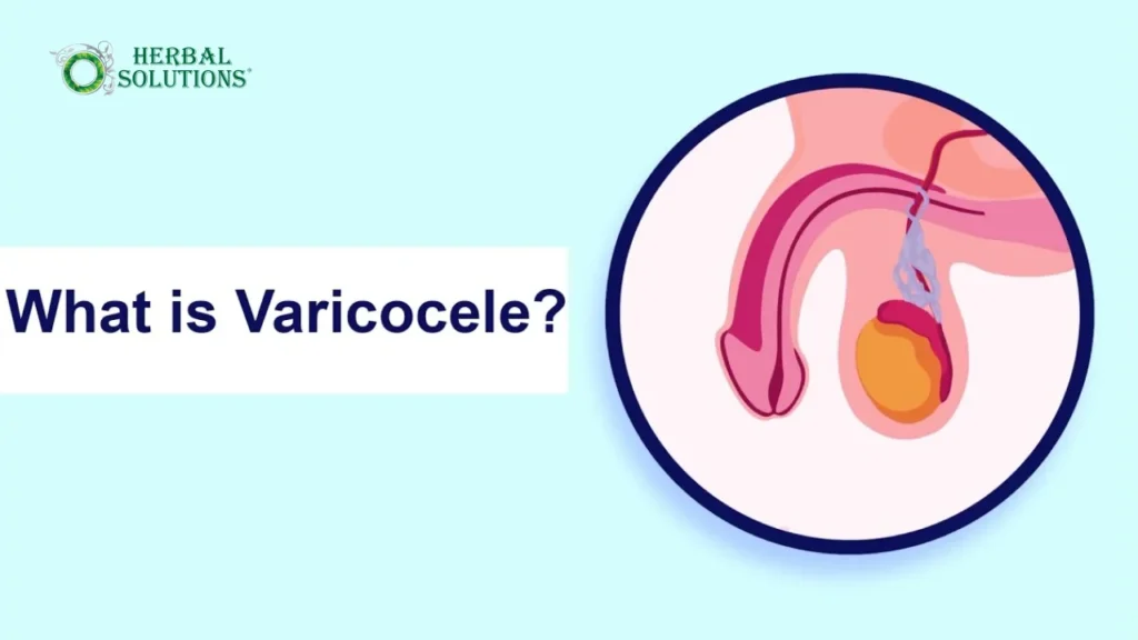 Varicocele Treatment in Pakistan